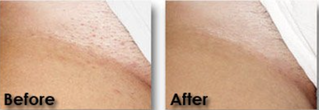 laser hair removal bikini before and after